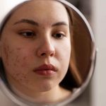 skincare penghilang komedo membandel