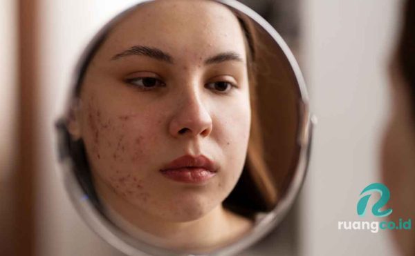 skincare penghilang komedo membandel