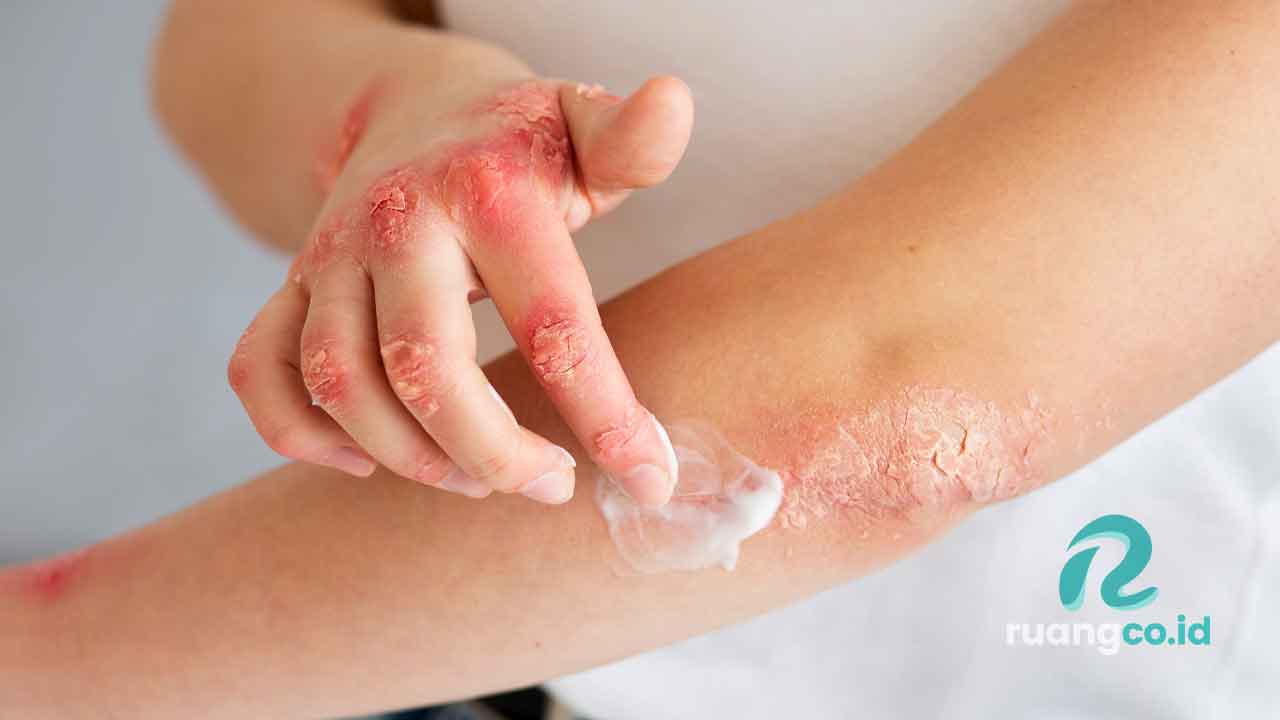 infeksi jamur kulit